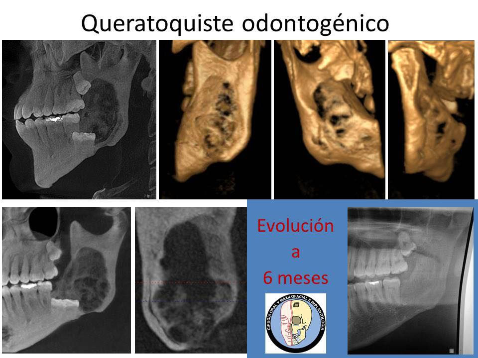 Queratoquiste odontogénico