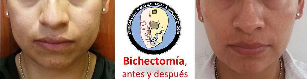 Bichectomía