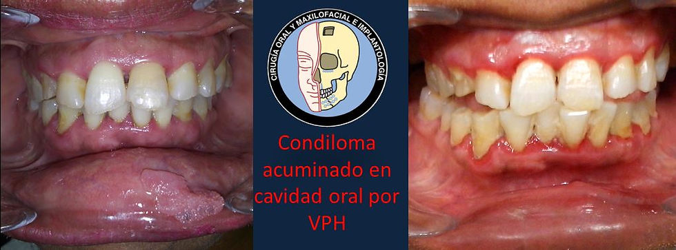 Condiloma acuminado oral