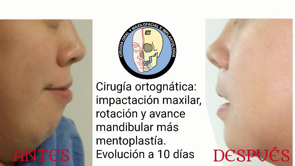 Cirugía ortognática