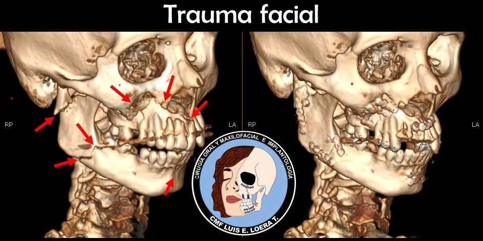 Trauma facial