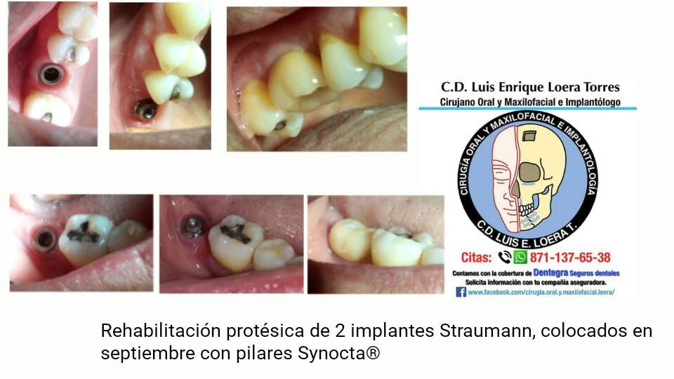Rehabilitacion con implantes