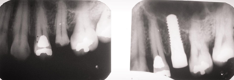 Implante dental