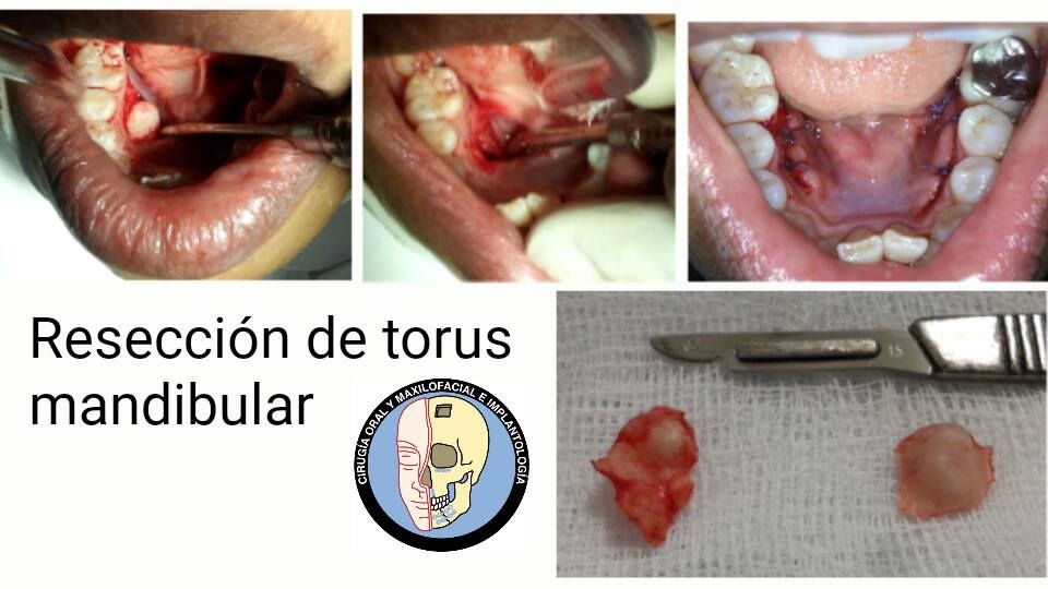 Resección de torus mandibular