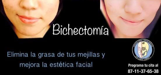 Bichectomía