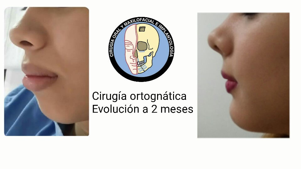 Cirugía Ortognática