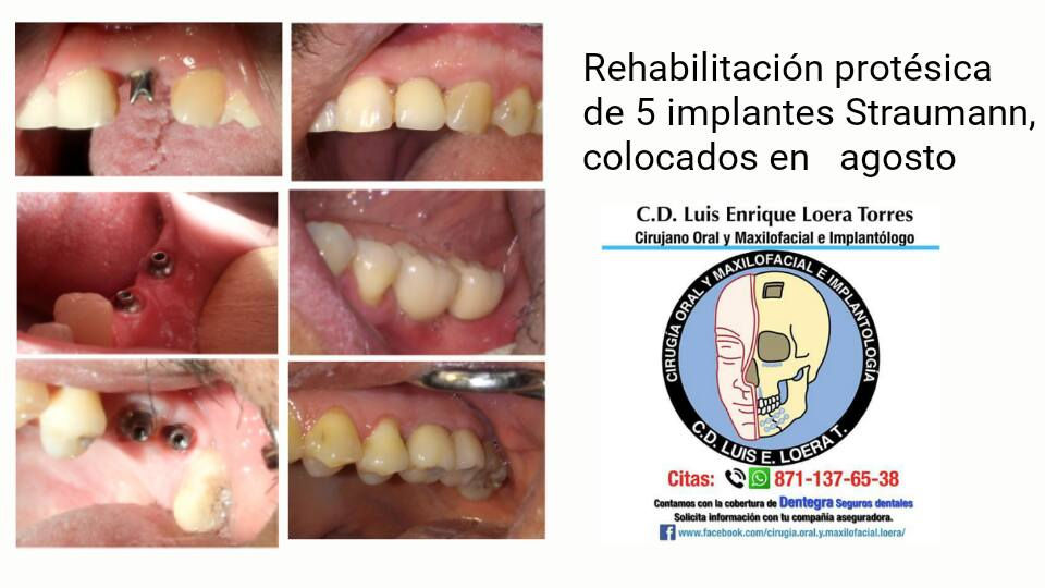 Rehabilitación quirúrgico protésica