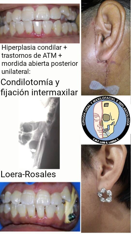 condilotomía