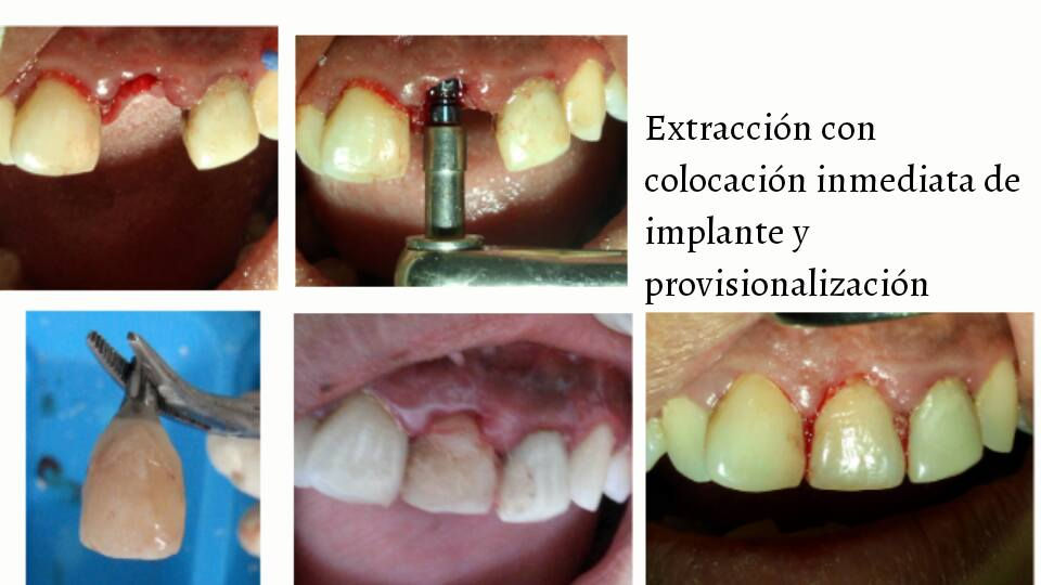 extraccion mas implante y provisional