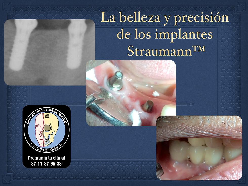 Implantes dentales