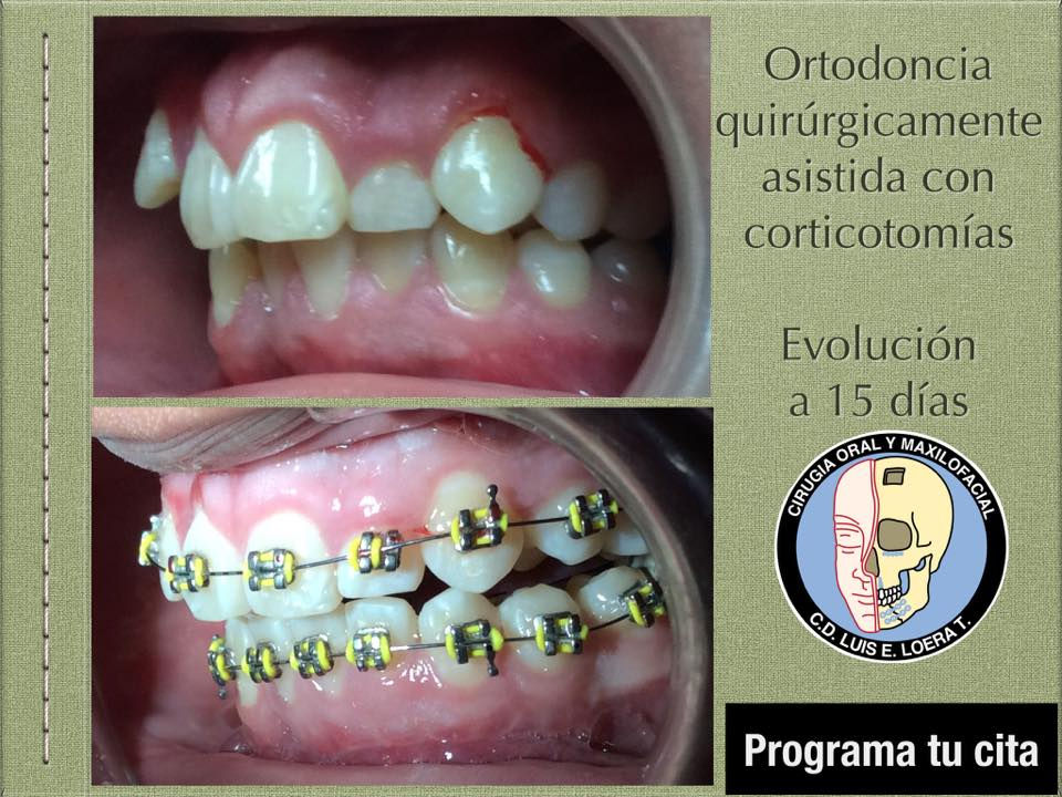 Ortodoncia quirúrgicamente asistida