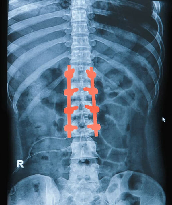 spinalsurgery3_edited.jpg