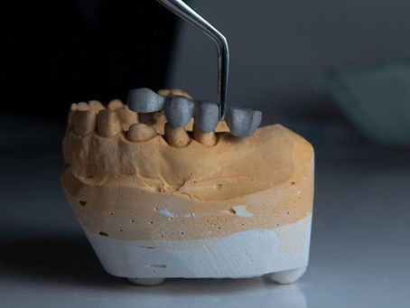 Dental Cements for Crowns and Bridges and How To Ensure a Secure Fit