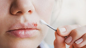 how-to-get-rid-of-a-cold-sore-800x450.jpg