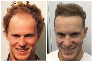 before and after photo of man who had a hair transplant