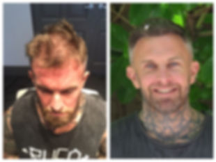 before and after photo of man who had a hair transplant