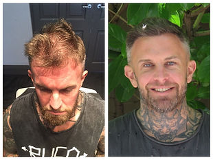 before and after photo of man who had a hair transplant