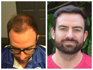 before and after photo of man who had a hair transplant