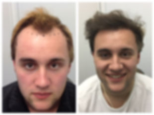 before and after photo of man who had a hair transplant
