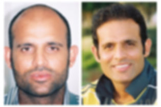 before and after photo of man who had a hair transplant