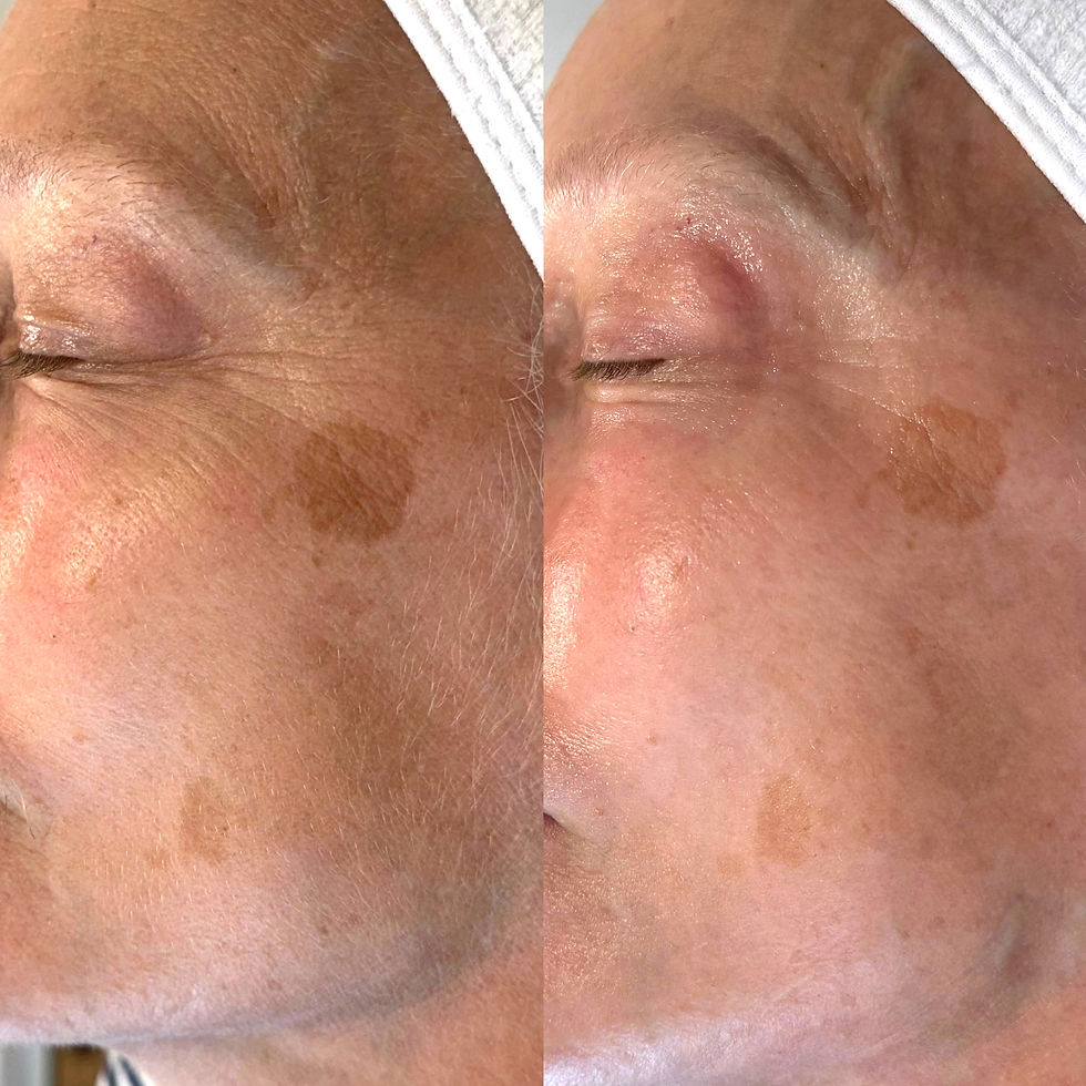 Before and after photo of lightening dark spots on the face from a chemical peel.