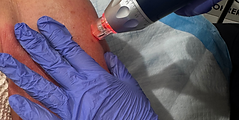 RF Microneedling.png