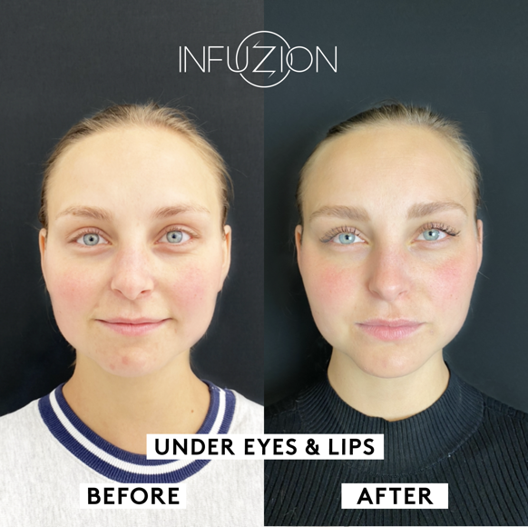 Infuzion_Volymizer_Before_After_Madeleine.png