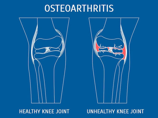 🦴 Osteoarthritis Slowing You Down? Restore Comfort Naturally! 🌿