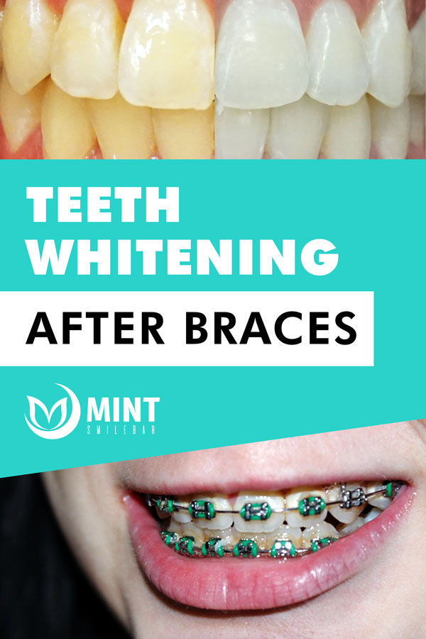 Teeth whitening after braces