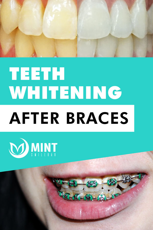 Teeth whitening after braces