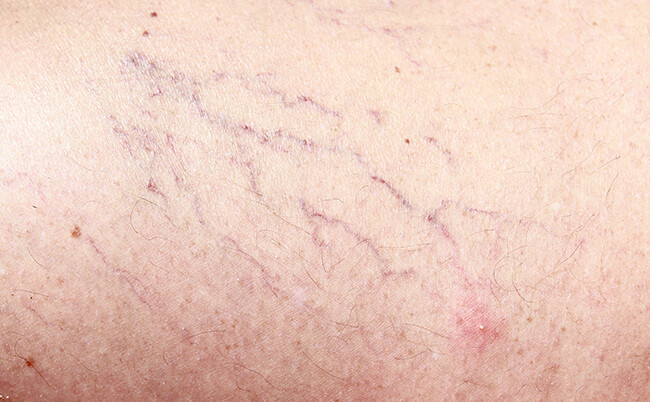 Spider-Vein-Treatment-Medicine-of-Cosmetics.jpeg