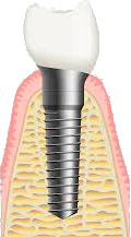 enxerto.png