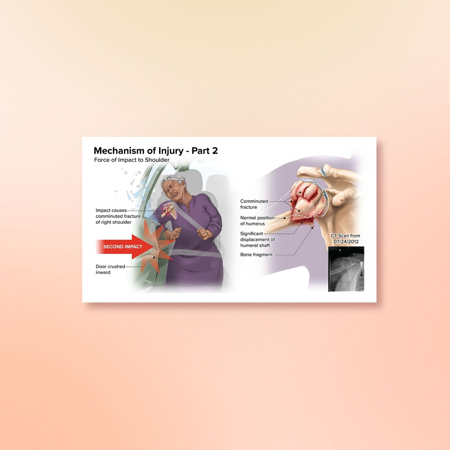 Shoulder Trauma Case Study