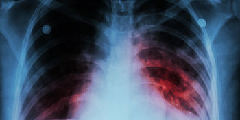 Protege tu salud contra la tuberculosis