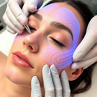 microneedling facial.jpg