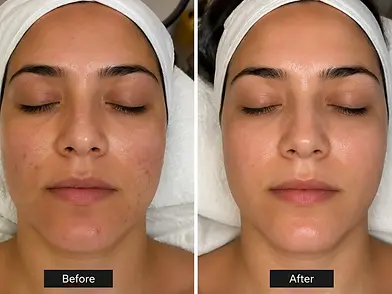 steaming_facial_luton_transformation2.webp