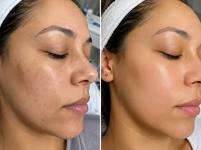 derma_planing_luton_transformation3.webp