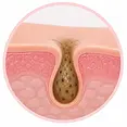 Congested_&_Blocked_Pores.webp