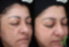 Melasma-2.jpg