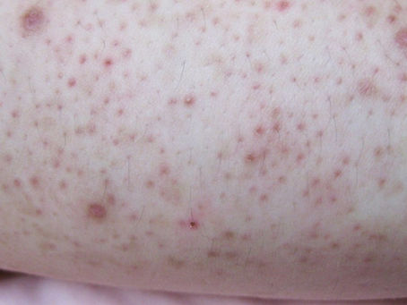 Queratose Pilar: escolha o tratamento dermatológico adequado