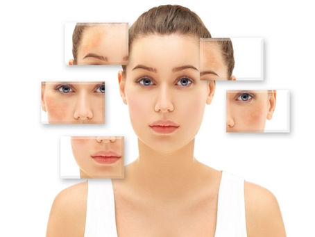 Melasma: disfunção de pigmentação da pele