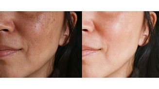 Manchas-de-sol-melasma.jpeg