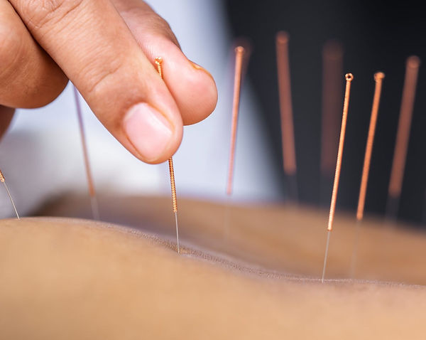 Acupuncture-Bio-restoration-scaled-2560x1280.jpeg