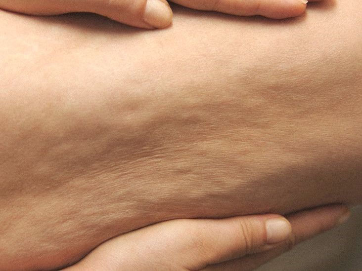 Simple Tips for Smooth Cellulite-Free Skin.jpeg