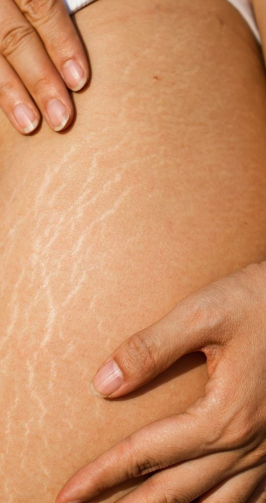 What Are the Best Exercises to Get Rid of Cellulite_.jpeg