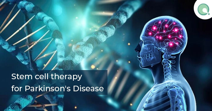Future of Parkinson’s Disease Treatment with Stem Cell Therapy