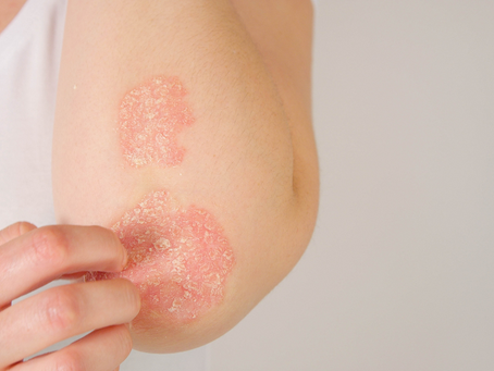 ATOPIC DERMATITIS