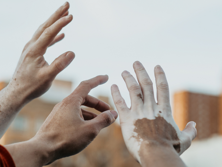 VITILIGO