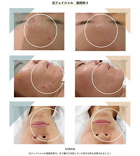 フォトフェイシャル | エステサロンヌトォア 弾力UP・しみ改善・小じわ