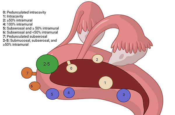 Uterine fibroid diagram.png
